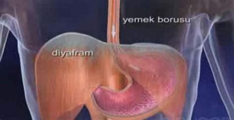 Yemek Borusu Ağrısı